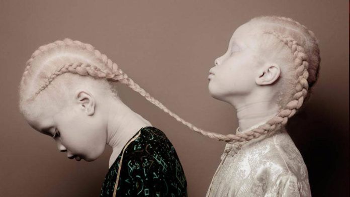 Zdjęcie przedstawia bliżniaczki-albinoski, które stoją jedna za drugą. Obie mają warkocze. Jedna dziewczynka ma opuszczoną głowę, a jeden warkocz spoczywa na ramieniu drugiej. Druga dziewczynka ma głowę podniesioną.
