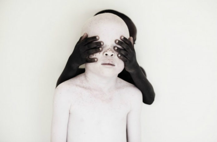 Czarne dziecko zakrywa albinosowi oczy.