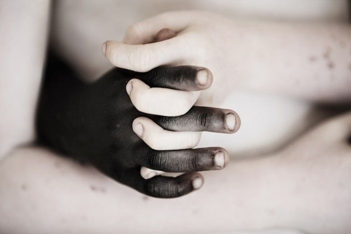 Uścisk dłoni zdrowego Tanzańczyka i albinosa.
