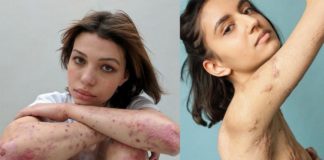 Dwa zdjęcia przedstawiające dwie kobiety z bliznami na ciele
