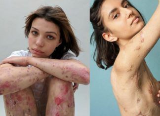 Dwa zdjęcia przedstawiające dwie kobiety z bliznami na ciele