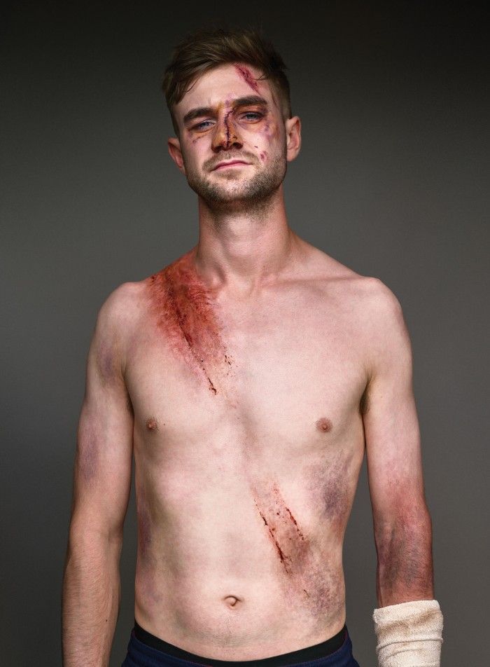 Mężczyzna z ranami po wypadku samochodowym