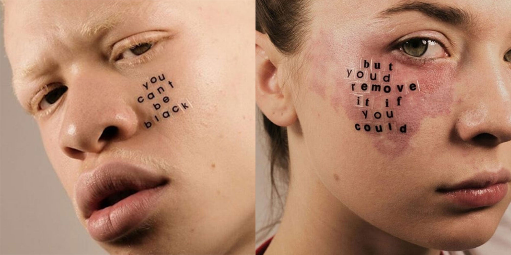 Dwie fotografie: z lewej meżczyzna cierpiący na albinizm z naklejonym na twarzy napisem po angielsku Nie możesz być czarny. Z prawej kobieta z czerwonym znamieniem na twarzy, na którym ma naklejony napis po angielsku Usunęłabyś to, gdybyś mogła.