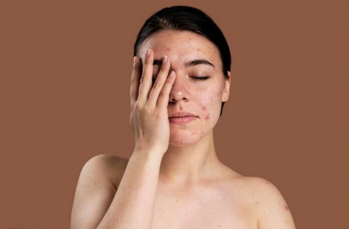 Trądzik wpływa na piękno Twojej skóry? Warto zapytać lekarza o leki